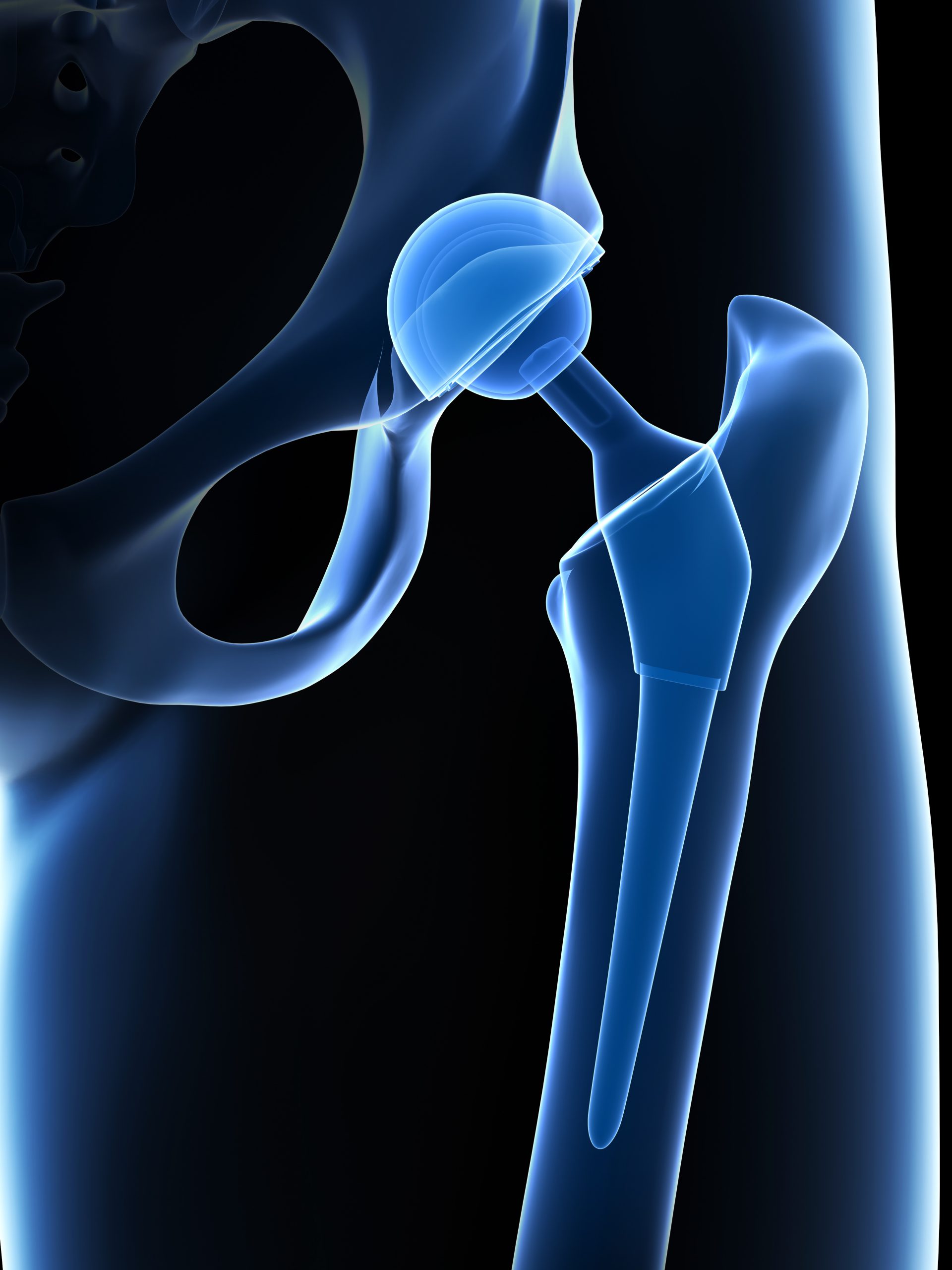 Künstliches Hüftgelenk bei Arthrose - Hüftspezialist – Dr. Raimund Völker