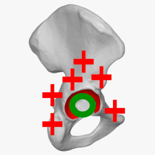 Anterolateral Zugang (Watson-Jones)