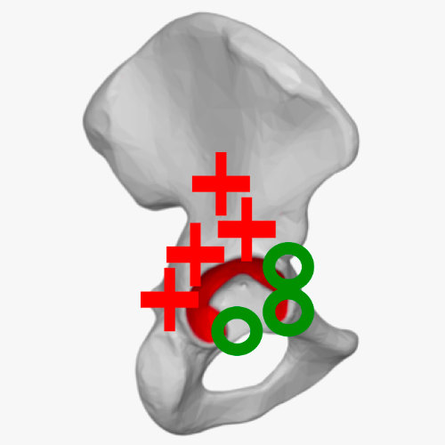 Direct anterior Zugang (Smith-Petersen)