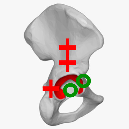 Lateraler transglutealer Zugang